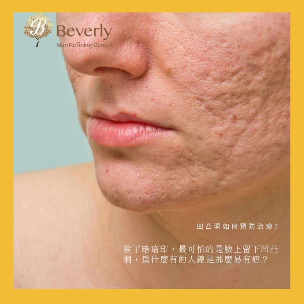 激光脫毛：人生美容療程No.1 Beverly 推薦 3 波段冰感脫毛療程
