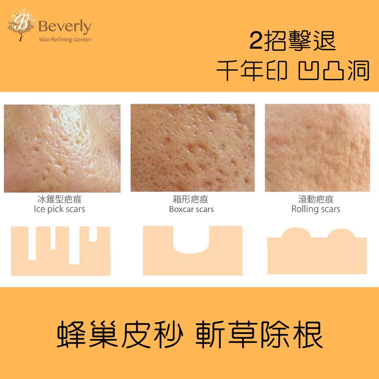 皮秒PICO LASER 3去凹凸洞暗瘡印有效嗎？｜推介755蜂巢皮秒激光2021｜Beverly Skin Refining Center hk