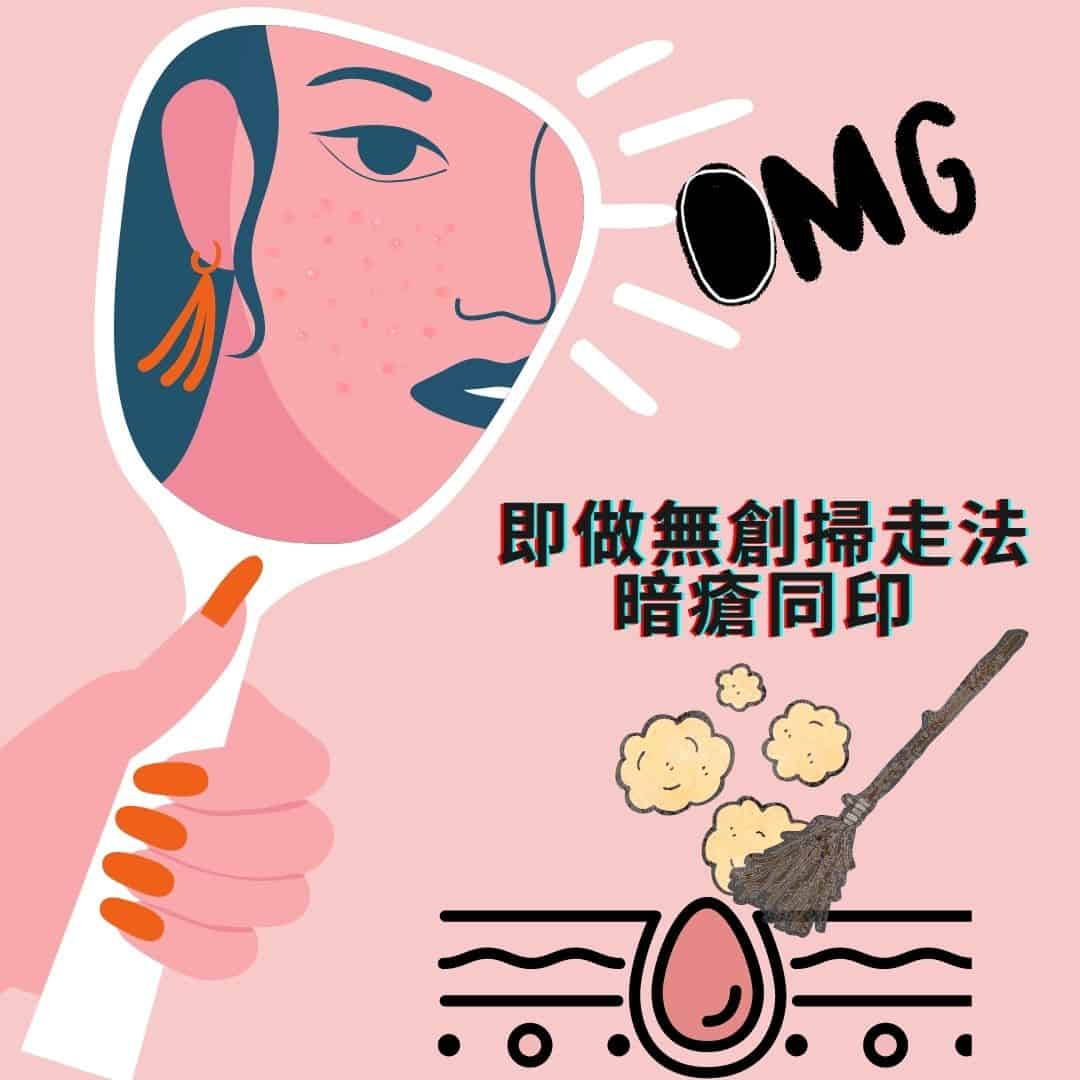 BeverlySkin深入了解去暗瘡及消除暗瘡印！陶瓷肌同皮秒好唔好？