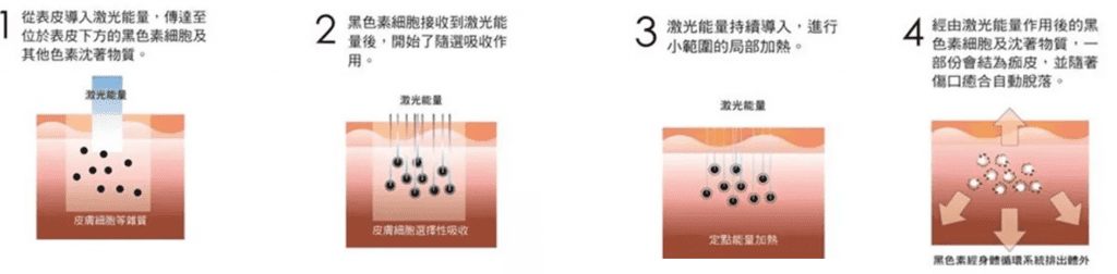 Helios Laser 納秒激光去色素荷爾蒙斑 打造嫩滑透亮肌