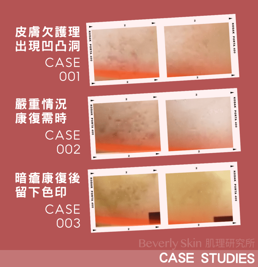 Beverly Skin PICO Laser 蜂巢超皮秒激光 實際治療凹凸洞案例