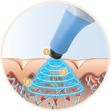 2024-20258去眼袋必選 BTL Exilis Ultra 360眼袋槍眼部+額頭