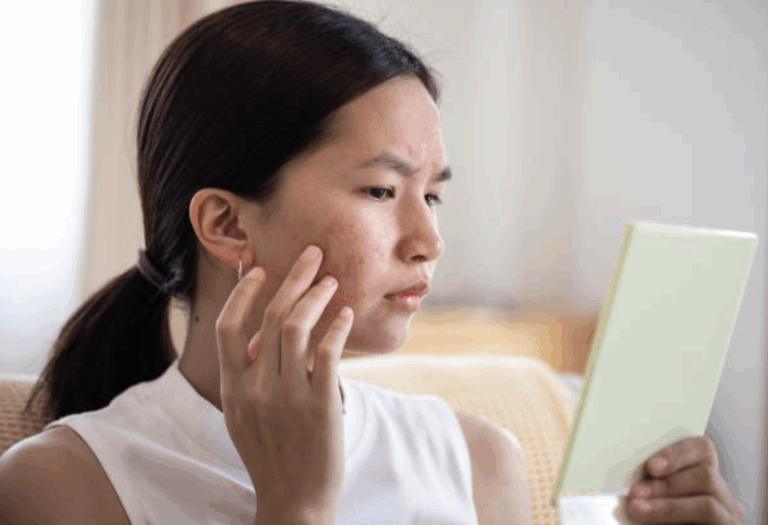 暗瘡發炎又紅又痛點算好？Beverly皮膚專家指南：從成因、急救到醫學治療，徹底告別石頭瘡與膿瘡煩惱
