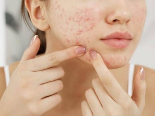 acne-ptmrk1rawrlkflbjdt6za4oqfrjulkdf87kigu5ibi