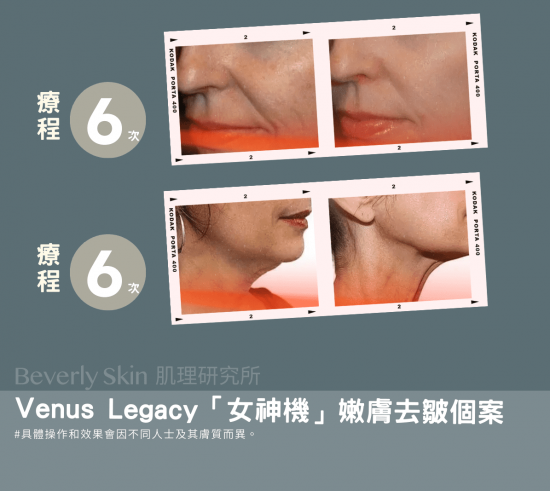 Venus Legacy「女神機」嫩膚去皺個案