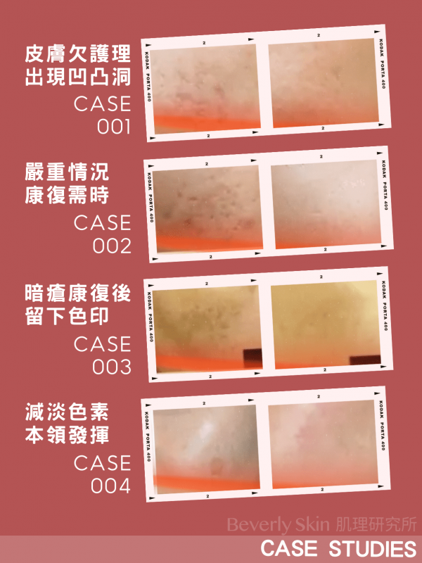 Beverly Skin PICO Laser 蜂巢超皮秒激光 實際治療凹凸洞暗瘡印案例