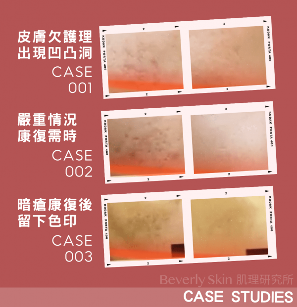 Beverly Skin PICO Laser 蜂巢超皮秒激光 實際治療凹凸洞案例
