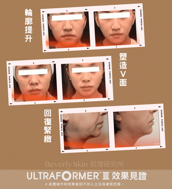 ULTRAFORMER III 效果見證