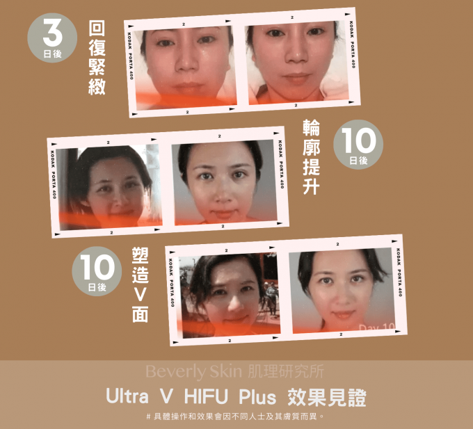 Ultra V HIFU Plus 效果見證